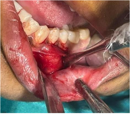 Figure 2: Incision placed and blunt dissection done.