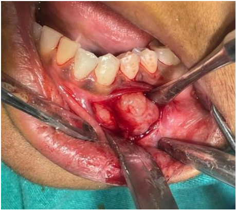 Figure 3: Excisional biopsy of the nodule.