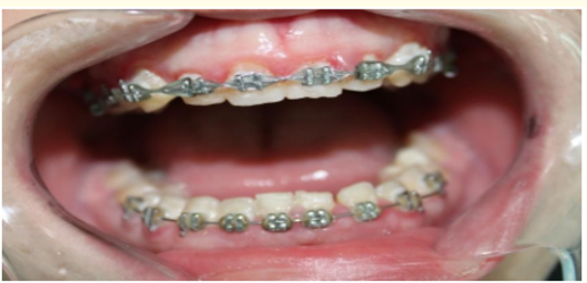 Figure 4: Patient with Gingival Hyperplasia at T0
of gingival enlargement of grade 3.