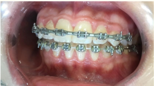 Figure 7: Patient with Gingival Hyperplasia at T1
of gingival enlargement of grade 1.
