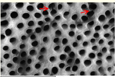 Figure 1: A SEM photomicrograph for the coronal third of a
non-irradiated ‘5.25% NaOCl + EDTA’ irrigated root canal surface
“Group I, subgroup B” showing a clean, debris free surface with
many visible dentinal tubule’s open