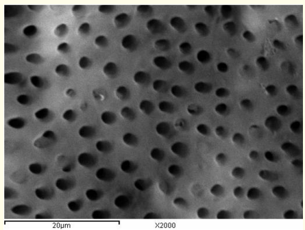 Figure 11: A SEM photomicrograph for the apical third of a
non-irradiated ‘5.25% NaOCl + MTAD’ irrigated root canal surface
“Group I, subgroup C” showing an almost clean, debris free surface
with visible dentinal tubules openings (X 2000).