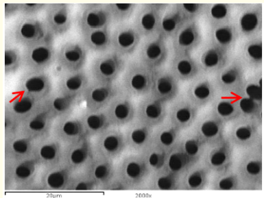 Figure 2: A SEM photomicrograph for the coronal third of an irradiated ‘5.25% NaOCl + EDTA’ irrigated root canal surface “Group
II, subgroup B” showing a clean, debris free surface with many
visible dentinal tubule’s openings and areas of erosion (X 2000).