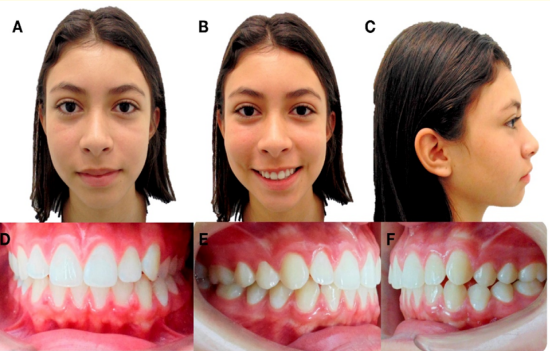 Figure 1: Initial extraoral and intraoral photographs.
A) Frontal resting. B) Frontal smiling. C) Profile.
D) Frontal intraoral. E) Right Lateral. F) Left Lateral. 
