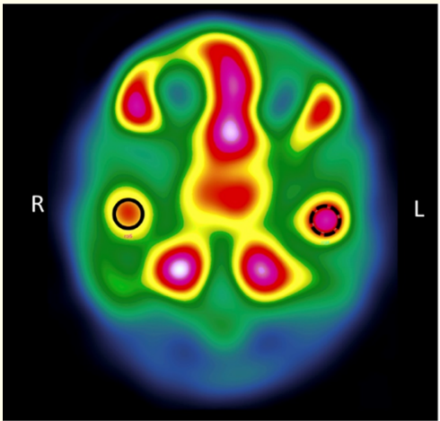 Figure 10: Single photon emission computer tomography
(SPECT).