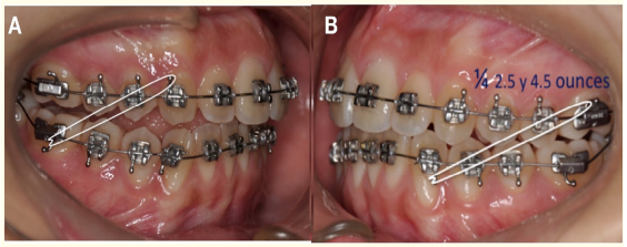 Figure 12: Elastic mechanics.
A) Lateral right intermaxillary elastic ¼ 2.5 ounces Class II vector. 

