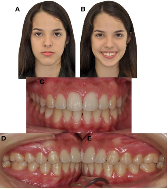 Figure 13: Final extraoral and intraoral photographs.
A) Frontal resting. B) Frontal smiling. C) Frontal intraoral.
 D) Right Lateral. E) L