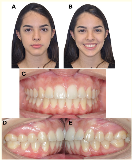 Figure 15: Extraoral and intraoral photographs. Control of
retention 3 years after treatment A) Frontal resting. B) Frontal
smiling. C) Frontal intraoral. D) Right Lateral. E) left Lateral. 
 