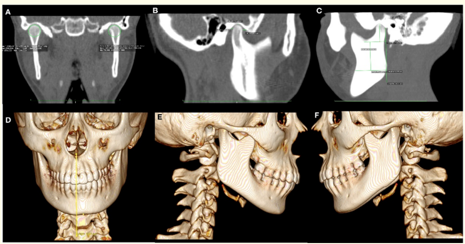 Figure 3: CT. A) Coronal slice showing higher volume in the right condyle. B) Sagittal right slice showing higher length of this condyle.
C) Sagittal left slice. 3D Reconstruction of bone tissues. D) Frontal view showing the magnitude of mandibular lateral deviation. E) Right
sagital slice presenting only one mandibular body. F) Left sagittal slice presenting two mandibular bodies. 