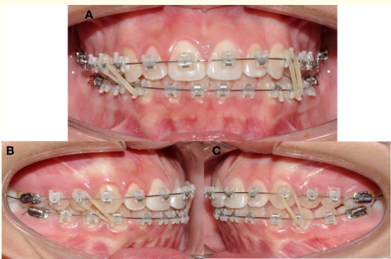Figure 5: Elastic mechanics. A) Intraoral frontal view. Brackets
Empower clear AO (American Orthodontics) MBT prescription. B)
Lateral right intermaxillary elastic ¼ 2.5 ounces Class III vector.
C) Lateral left intermaxillary elastic ¼ 2.5 ounces Class II vector