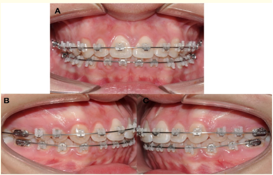 Figure 6: Stainless steel upper and lower archwires
AO .019x .025”. A) Frontal view. B) Right view. C) Left view.
