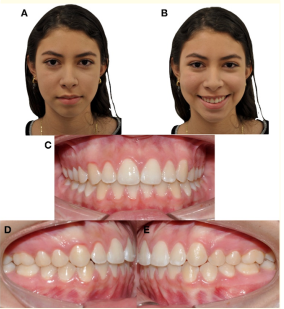 Figure 7: Extraoral and intraoral final photographs.
 A) Frontal resting. B) Frontal smiling. C) Frontal intraoral. 