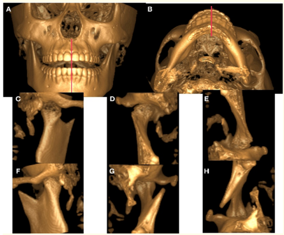 Figure 8: Control CT. 3D reconstruction of bone tissues taken at
the end of treatment with open mouth. A) Frontal View. B) Axial
View. 3D reconstruction of bone tissue from different angles to
show the condyle after 12 months of condylectomy. C) Posterior
View. D) Frontal View. E) Axial View. Contralateral condyle F)
Posterior View. G) Frontal view. H) Axial View.