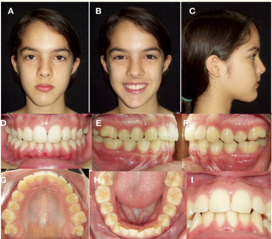 Figure 9: Initial extraoral and intraoral photographs.
A) Frontal resting. B) Frontal smiling. C) Profile.
D) Frontal intraoral. E) Right Lateral. F) Left Lateral. 
