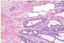 Figure 1: Radial scar demonstrating glandular structures layered with ductal epithelial cells intermingled with foci of usual ductal hyperplasia and surrounding collagen-rich, sclerotic stroma [7]. 