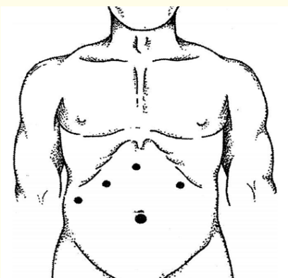 Figure 3: Scheme of trocar placement.