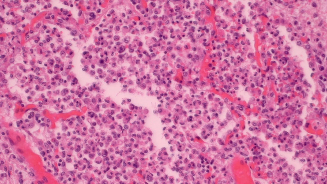 Figure 2: DIP with non-pigmented macrophages (histiocytes), H&E stain, medium power.