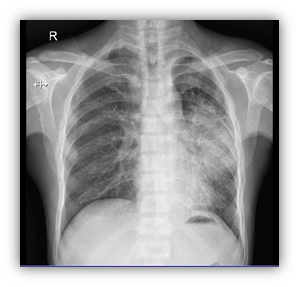Figure 2: Chest x ray showing non-homogenous opacity left mid zone.