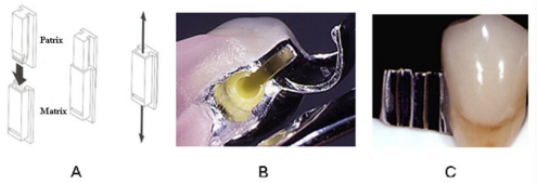 Figure 1: Show male (Patrix) and female (Matrix) part of
precision attachment, where (A) Male and Female part how they
connect, (B) Image of Female, (C) Image of Male.