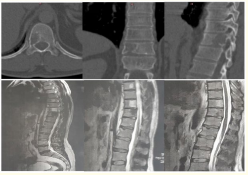 Figure 1: CT-scan and Sagittal MRI shows lytic change (bone
destruction) on the right lateral pedicles arches of Th- 11.