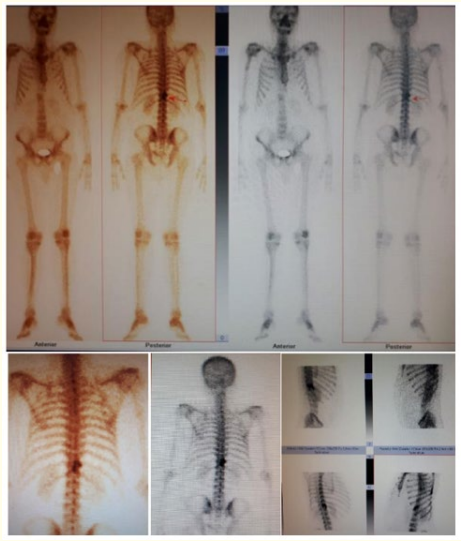 Figure 2: The bone scan showed a more intense accumulation
of the tracer on the affected side of the vertebra, as well as an
osteolytic defect in the right lateral part, indicative of an unusual
mixed osteolytic-osteoblastic metastatic pattern located at the
Th-11 thoracic vertebra. Additionally, static spots were observed
in the anterior, posterior, lateral, and oblique projections,
further confirming the presence of metastatic malignant
melanoma in the affected vertebra.