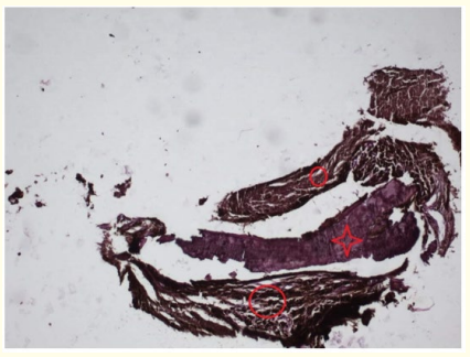 Figure 3: Histopathological outcome of Metastatic Malignant
Melanoma (circle corresponds to tumor tissue, star corresponds
to calcified bone trabeculae).