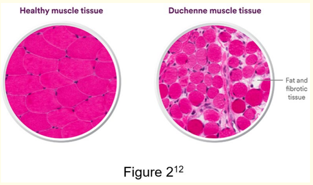 Figure 2: Healthy muscle tissue vs Duchenne Muscle Tissue
[12]. <br>
The image shows a visual comparing healthy muscle tissue and
Duchenne Muscular Dystrophy tissue.