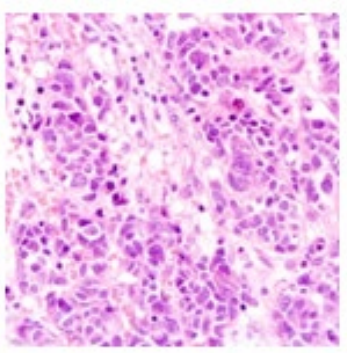 Figure 1: Neuroendocrine tumour depicting organoid nests
and ribbons of tumour cells imbued with granular eosinophilic
cytoplasm and eccentric nuclei with salt and pepper nuclear
chromatin. Tumour parenchyma is traversed by delicate strands
of fibro-vascular stroma [6].