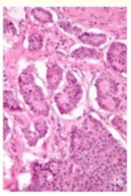 Figure 2: Neuroendocrine tumour delineating organoid nests
and ribbons of tumour cells impregnated with granular,
eosinophilic cytoplasm and eccentric nuclei salt and pepper
nuclear chromatin. Tumour parenchyma is traversed by delicate
strands of fibro-vascular stroma [7]. 
