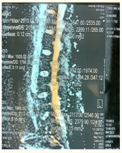 Figure 3: NP CDA: 0.129 (L4-L5) Day-0.