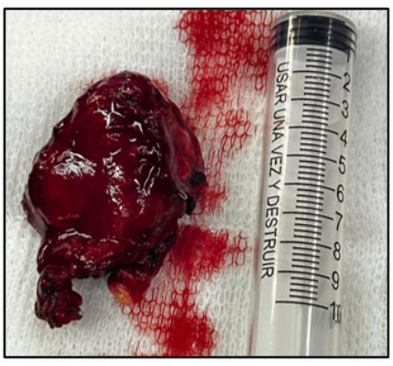 Figure 1: Carotid glomus tumor resection macroscopy piece.