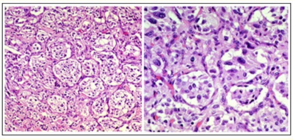 Figure 2: PGL epithelium in microscopic field. Cells in
trabecular pattern. (Adaptado de Silloo B Kapadia, MD.)