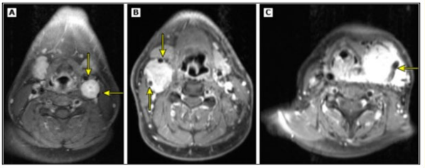 Figure 3: Clasificación según los criterios de Shamblin por RNM
(Adaptado de: Boedeker CC).