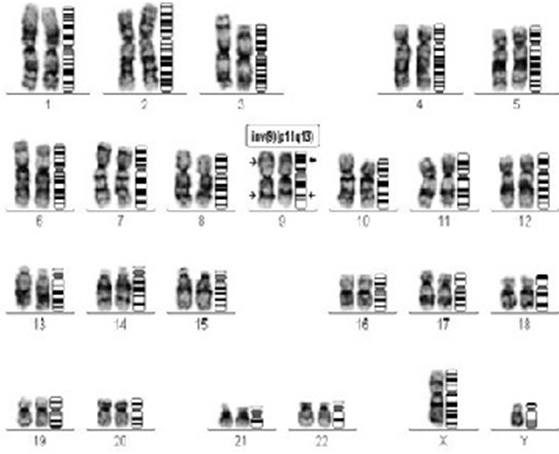 Figure 1: 
 Karyotype of pericentric inversion on the both chromosome 9 (46, XY. Inv 9 p11 q13) X 2.