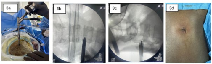 Figure 3: 3a, image of spine endoscopy being performed; 3b,
docking point for endoscope marked over skin under
fluoroscopy, 3c, L3 lamina being drilled, 3d, surgical port closed
with single non absorbable suture.