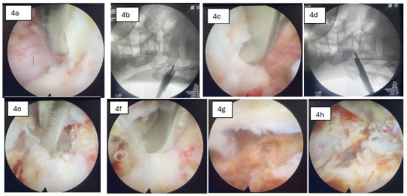 Figure 4: Intra operative endoscopic and fluoroscopic images
(3 O clock position of the above images corresponds to Cranial
& 9 O clock to caudal directions) 4a, upper most end of L3
lamina after removal of most of the L3 hemilamina on left side;
4b,intra op fluoroscopy confirming extent of laminectomy; 4c &
d , L4 laminar edge towards caudal direction with corresponding fluoroscopic image; 4e, endoscopic visualisation eroded
lower end plate of L3; 4f, L3-L4 disc; 4g, visualisation of ventral
epidural abscess 4h, after clearing the ventral epidural abscess
visualising beyond midline.