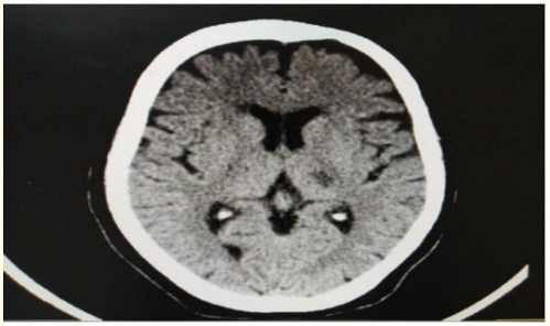 Figure 1: CT brain axial view follow up 24 hours after receiving
IV thrombolysis showing acute left lacunar hypodense lesion in
the posterior limb of internal capsule.