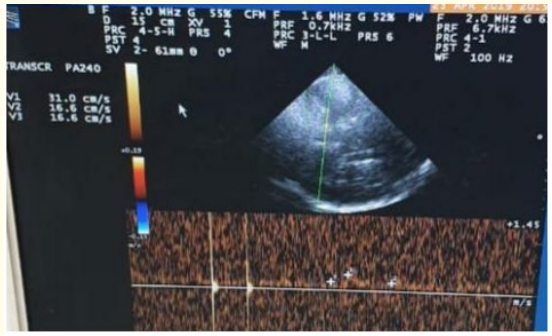 Figure 2: TCCD Transtemporal approach, Mesencephalic plane
of left M1 middle cerebral artery (MCA), 24 hours after
receiving IV thrombolysis showing normal PI (0.86) at the same
side of the lesion.