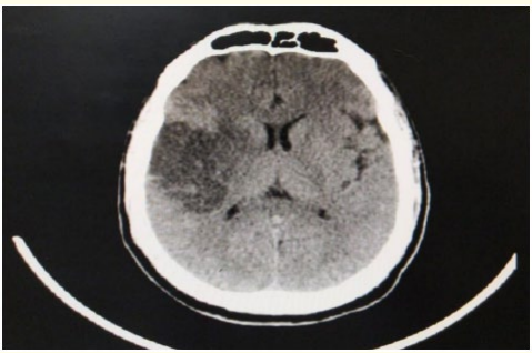 Figure 3: CT brain axial view follow up 24 hours after receiving
IV thrombolysis revealing acute right tempro-parietal Ischemic
infraction (M2 MCA).
