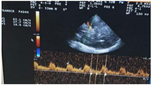 Figure 4: TCCD, Transtemporal approach, Mesencephalic plane
of right MCA, 24 hours after receiving IV thrombolysis showing
increased PI (2.13) at the same side of the lesion.