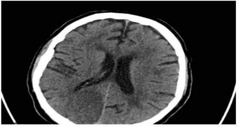 Figure 5: CT Brain without contrast axial view showing right
tempro-occipital acute ischemic infarction involving right PCA
territory.