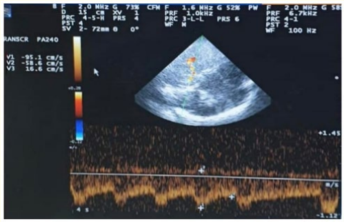 Figure 6: TCCD, Transtemporal approach, Mesencephalic plane
of right PCA, 24 hours after receiving IV thrombolysis showing
increased PI (2.13) at the same side of the lesion.