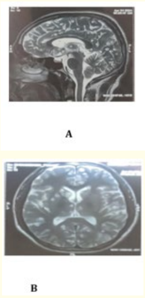 Figure 1: A, B. The brain MRI revealed multiple inflammatory
well-defined T2/FLAIR hyperintense and hypointense nodular
lesions with eccentric T2 hypointense scolex, diffusely scattered
at gray-white matter in both cerebral hemispheres, basal
ganglia, thalami, and bilateral cerebellar hemispheres
suggestive of disseminated intracranial neurocysticercosis in
varied stages in sagittal and axial sections. 