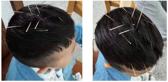 Figure 1: Application of Liu's scalp acupuncture therapy in treating the patient.