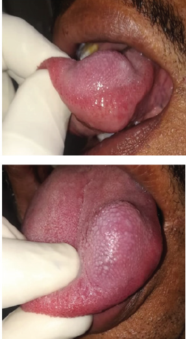 Figure 1: Showing mass on the anterior tongue.