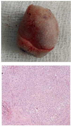 Figure 2: Showing excised on gross and HP examination