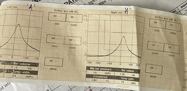 Figure 3: Tympanogram of the patient showing normal middle ear.