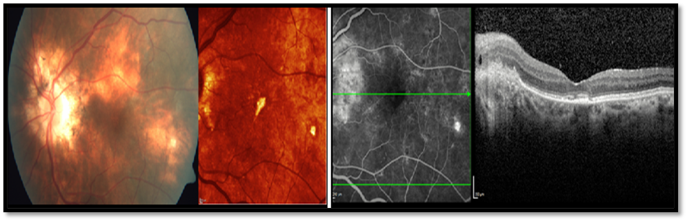 Figure 2: Fundus CP and MCI showing peripapillary granulomas and choroidal lesions. Corresponding FFA image showed hyperfluorescent lesions and OCT showed hyporeflective granulomas in a patient with Tubercular multifocal choroidal lesions.