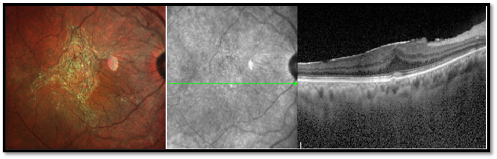 Figure 3: MCI showing ERM, which was not detected by IR imaging. OCT showing ERM with Central bouquet anomaly, in a patient with Tubercular multifocal choroidal lesions.