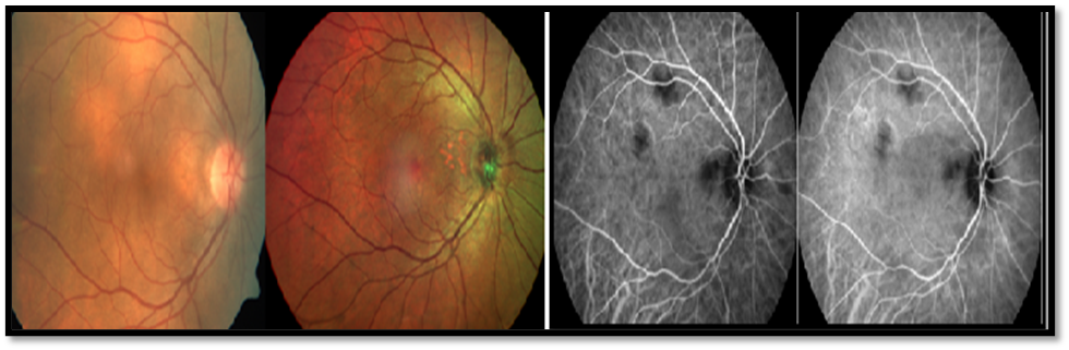 Figure 4: Fundus CP showing sub retinal yellow lesions but Multicolor imaging could not detect these choroidal lesions in probable ocular sarcoidosis. Corresponding ICGA showing hypofluorescence in the intermediate phase, this was maintained during the late phase.